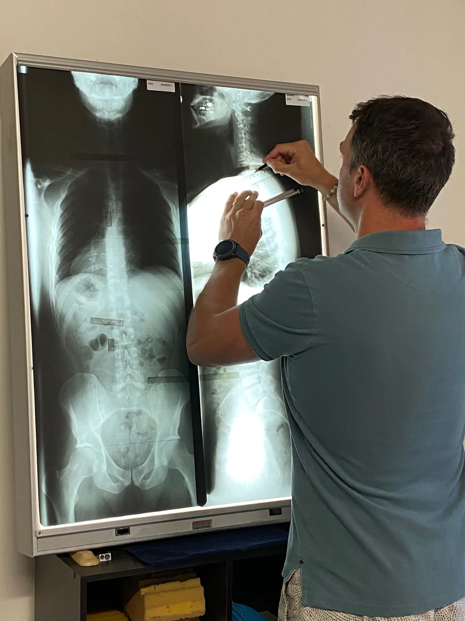 Dr Damien reviewing a patient's spinal x-rays on a lightbox